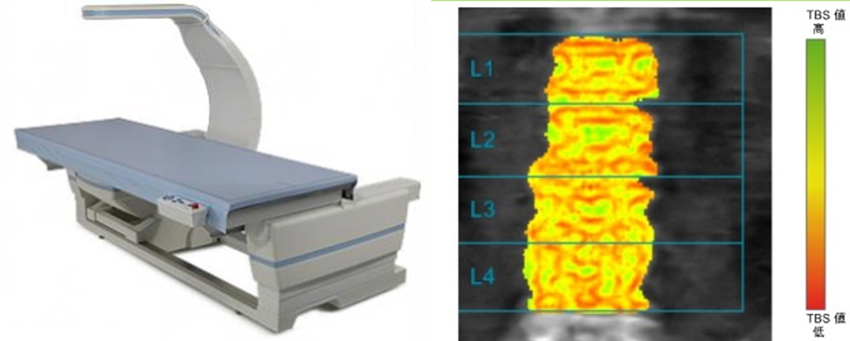 骨密度測定装置による検査の様子