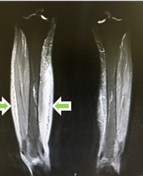 リンパ浮腫のイメージ図